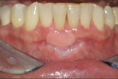 Free_Gingival_Graft_-_After
