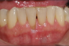 Free_Gingival_Graft_-_Before