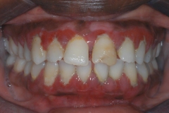 lanap_Before