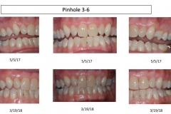 pinhole