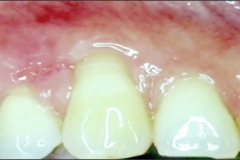Sub-Epithelial_Connective_Tissue_Graft_-_Before