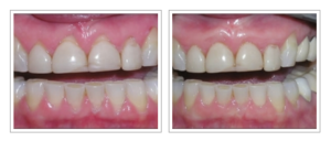periodontist-in-stuart-florida-before-after-pictures